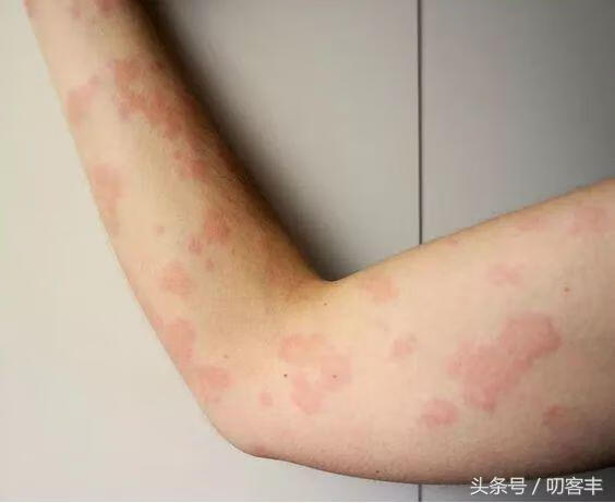 慢性寻麻疹是什么样图片(慢性荨麻疹反反复复怎么办)