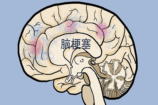 急性脑梗塞能治好吗(脑梗塞能彻底治好吗)