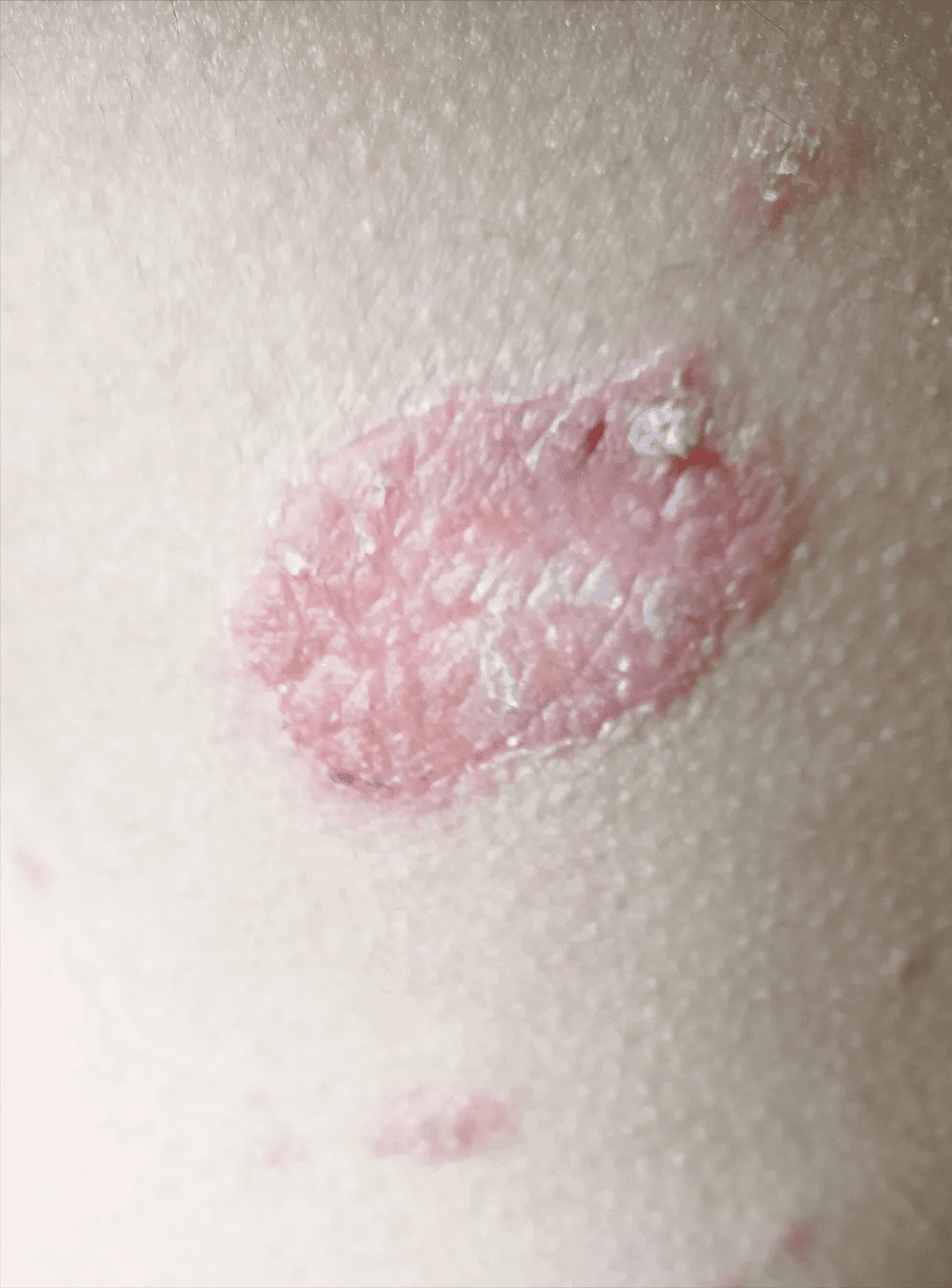 玫瑰糠疹早期症状图片