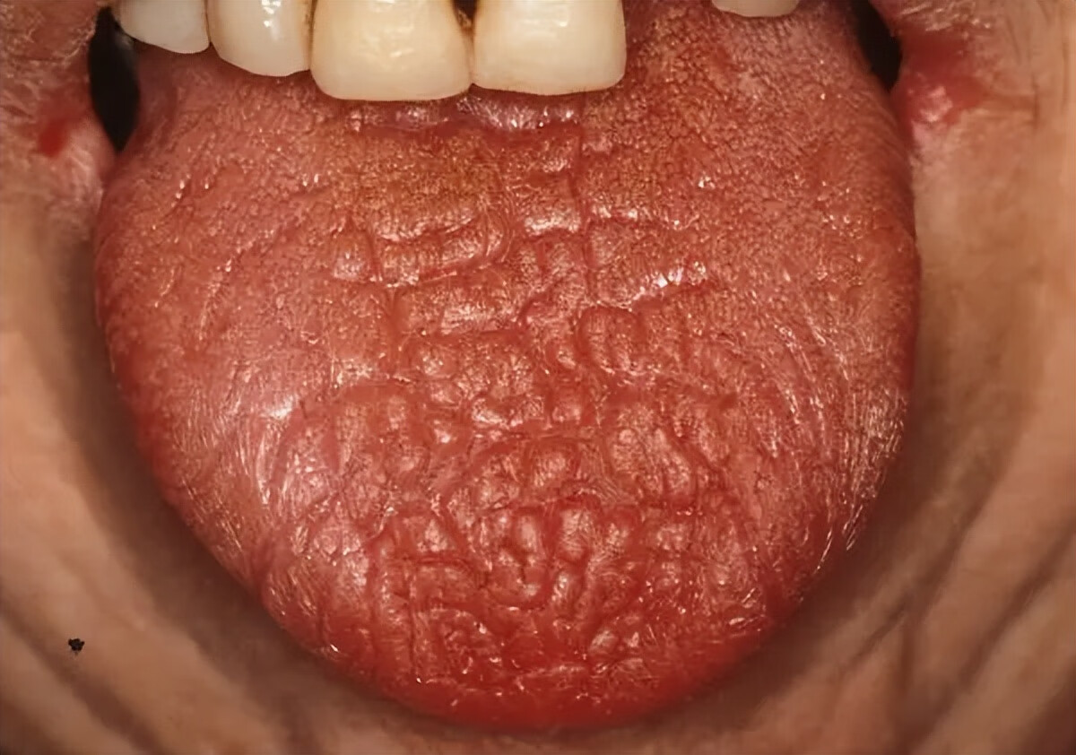 舌头有红色的小点点图片