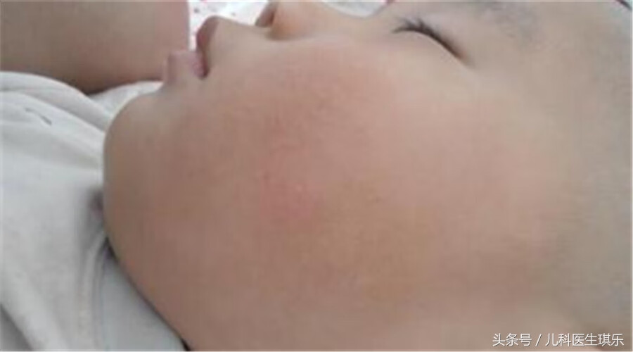 宝宝脸上有白斑什么原因造成的(宝宝脸上有白斑是缺什么)