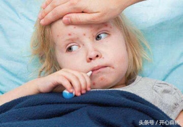 儿童寻麻疹会传染吗(荨麻疹会传染给家人吗)