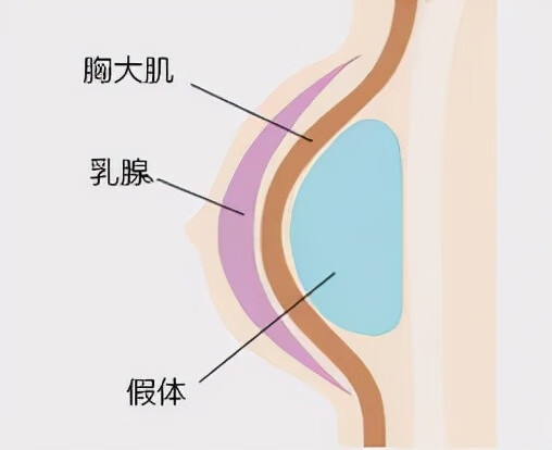 假体隆胸哺乳的风险(假体隆胸影响以后哺乳吗)