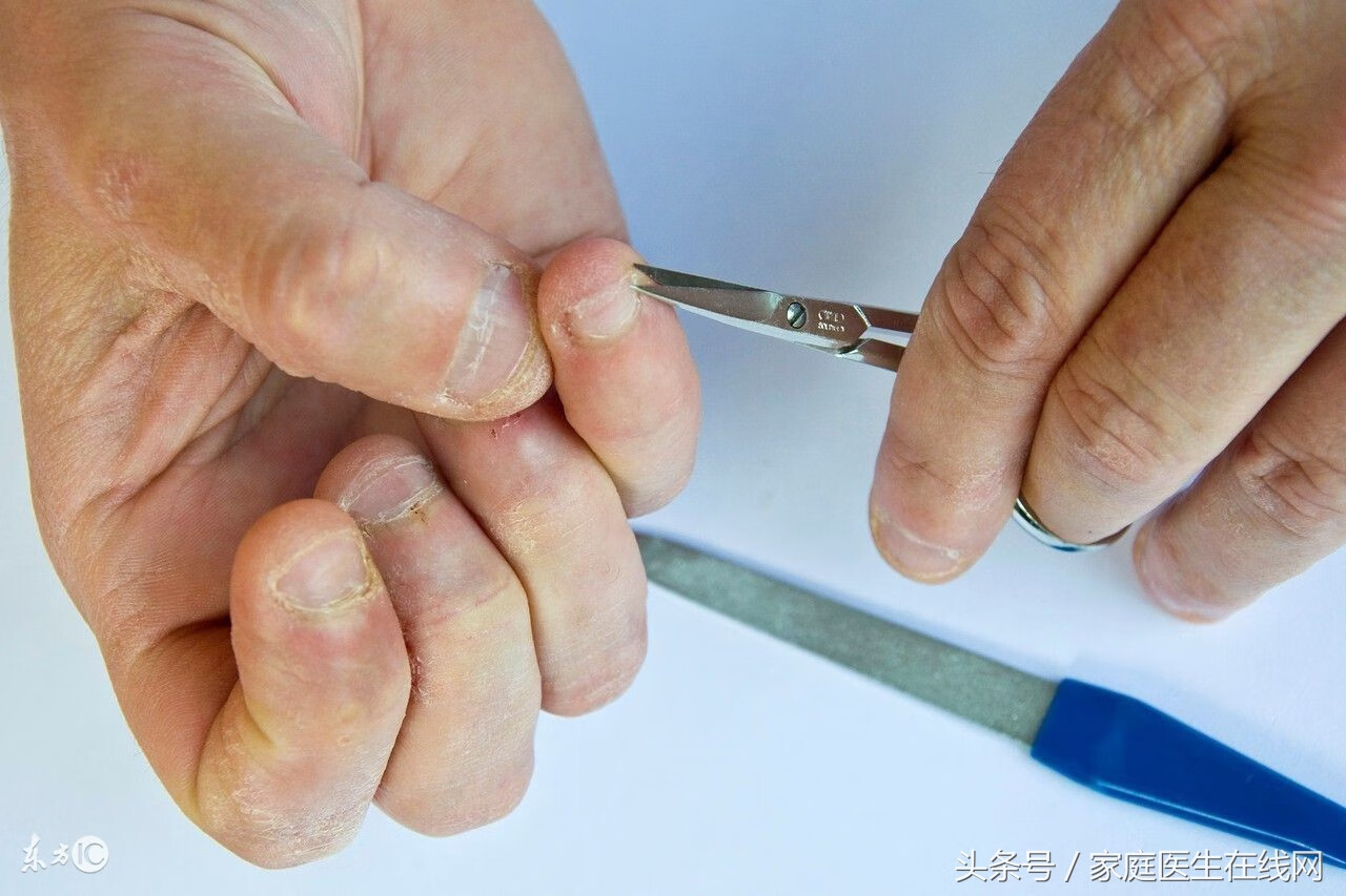 手指甲没有月牙代表什么(指甲上几乎没有月牙)