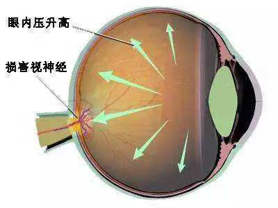 眼睛胀痛是怎么回事儿(眼睛胀痛怎么解决)