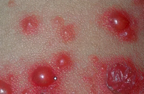 2,不全型带状疱疹主要体现为神经疼痛,没有皮损,像针刺一样,阵发性的
