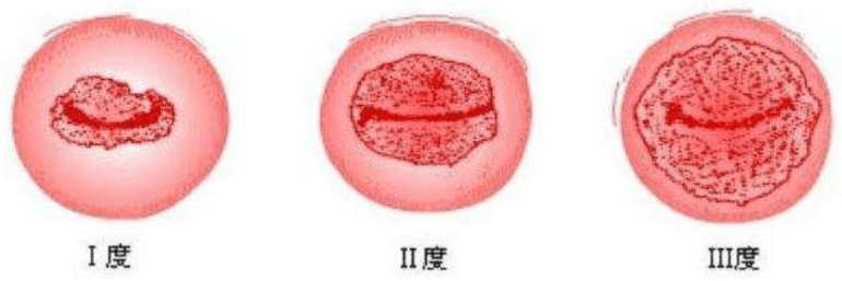 有关宫颈糜烂的治疗(宫颈糜烂的治疗方法哪种好)