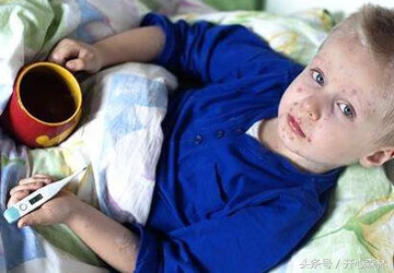 儿童寻麻疹会传染吗(荨麻疹会传染给家人吗)