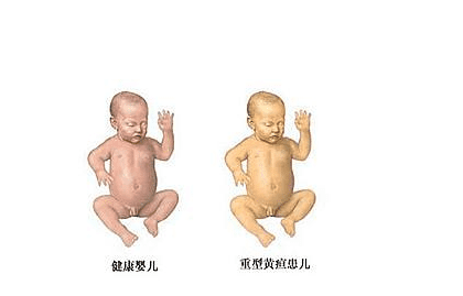新生儿黄疸多少是正常范围(关于新生儿黄疸的知识)