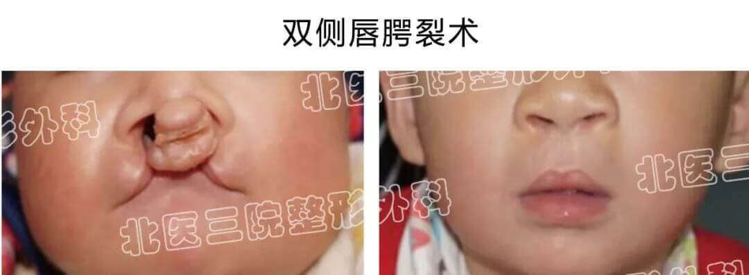 腭裂可以治好吗(腭裂可以治愈吗)