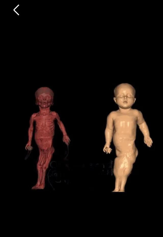 美人鱼综合症是什么(美人鱼综合症是什么病)