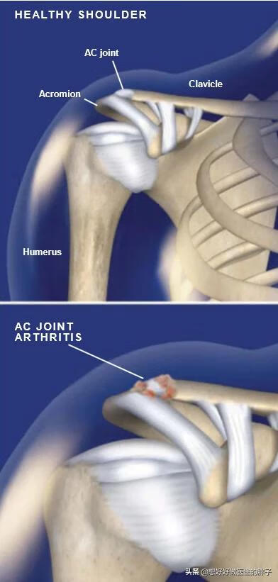 左肩膀疼痛是什么原因引起的(左肩胛骨疼痛是什么原因)
