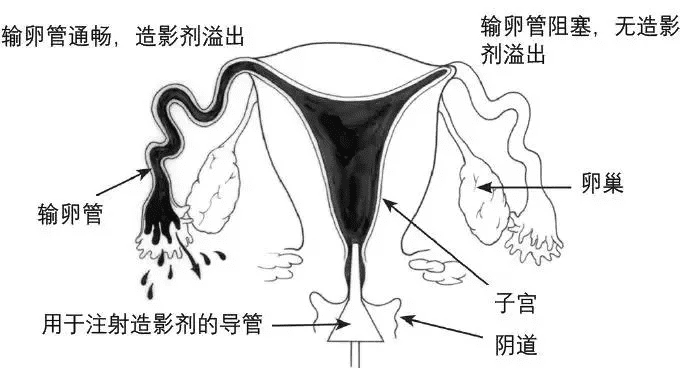 输卵管造影疼不疼阿