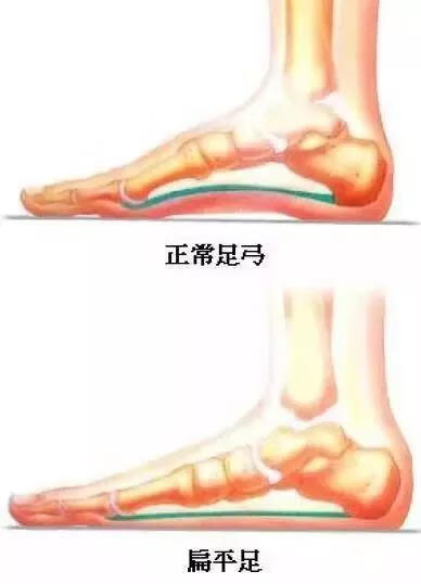 什么是扁平足?(扁平足是什么样)