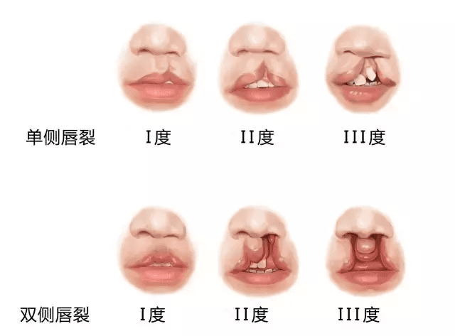 成人兔唇整形需要多少钱(北京嫣然做唇腭裂费用)