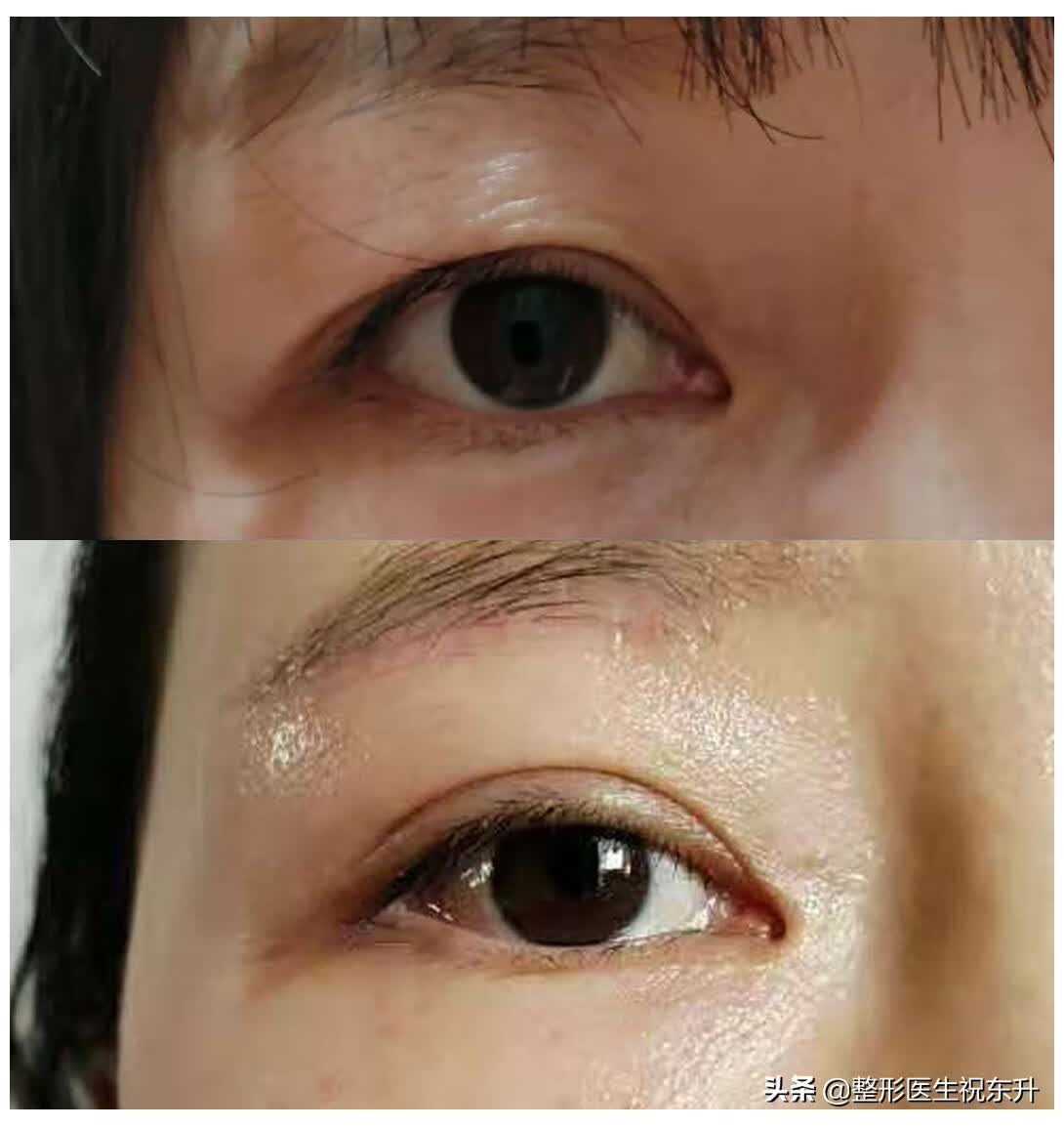 "提眉和切眉"傻傻分不清?听听祝医生怎么说