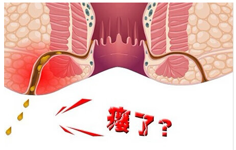 肛瘘是什么症状表现(肛瘘是什么症状表现图片)
