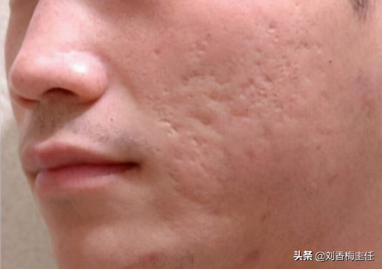 有痘坑怎么办啊(治疗痘坑最有效的方法是什么)