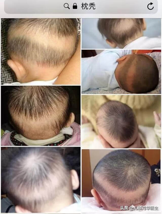 枕秃图片(枕秃正常吗)
