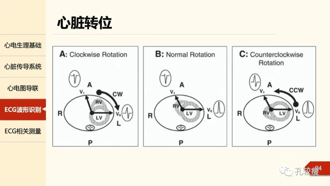 心电图导联位置示意图(心电图机导联位置图)