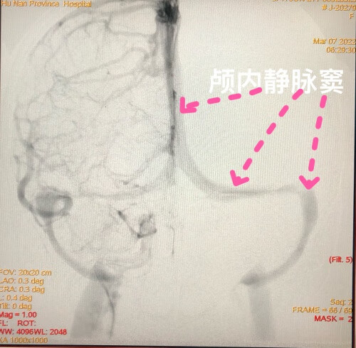 产后头痛是怎么回事(产后头疼的原因)