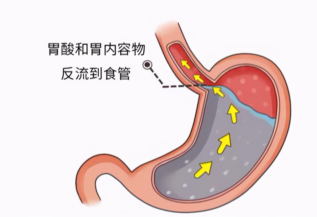 最常见于反流性食管炎,除外烧心症状,反流性食管炎还可以出现胃,食管