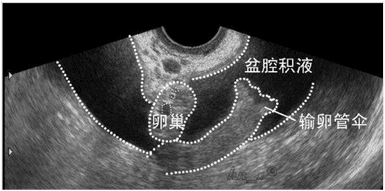 陶氏腔积液是什么意思(陶氏腔积液是什么原因)