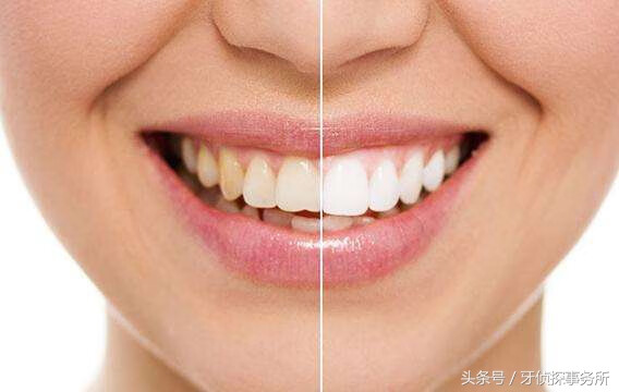 冷光牙齿美白原理(冷光美白对牙齿有伤害吗)