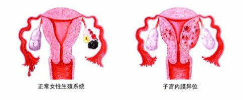 子宫内膜异位症有什么症状表现(子宫内膜异位症的症状)