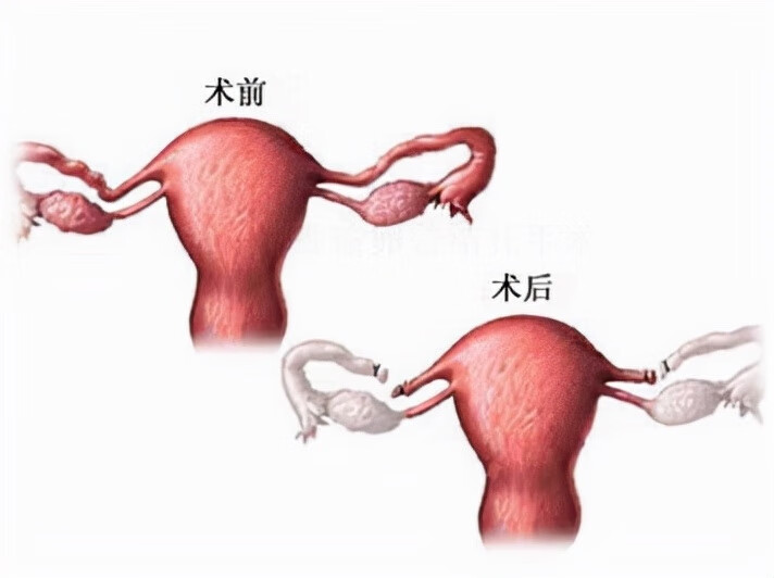 激光结扎手术还能恢复生育吗(结扎后还可以恢复生育吗)