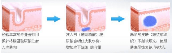 鱼尾纹怎么去除(去鱼尾纹)