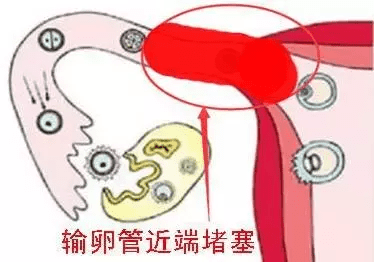 输卵管炎是什么原因引起的(急性输卵管炎是怎么引起的)