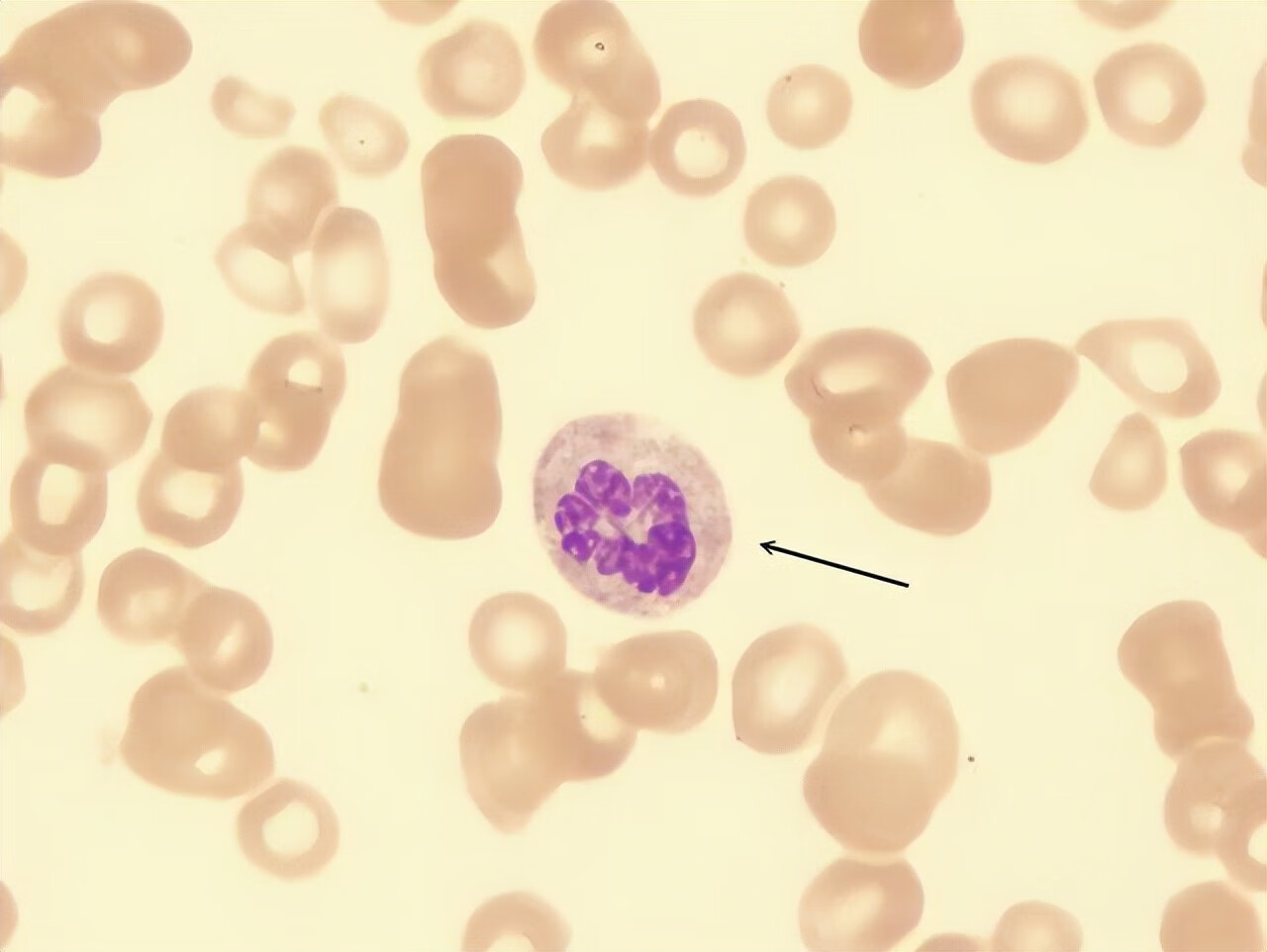 白细胞介素(白细胞标准是多少)