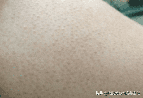 鸡皮肤用什么药最有效(鸡皮肤擦什么药好)
