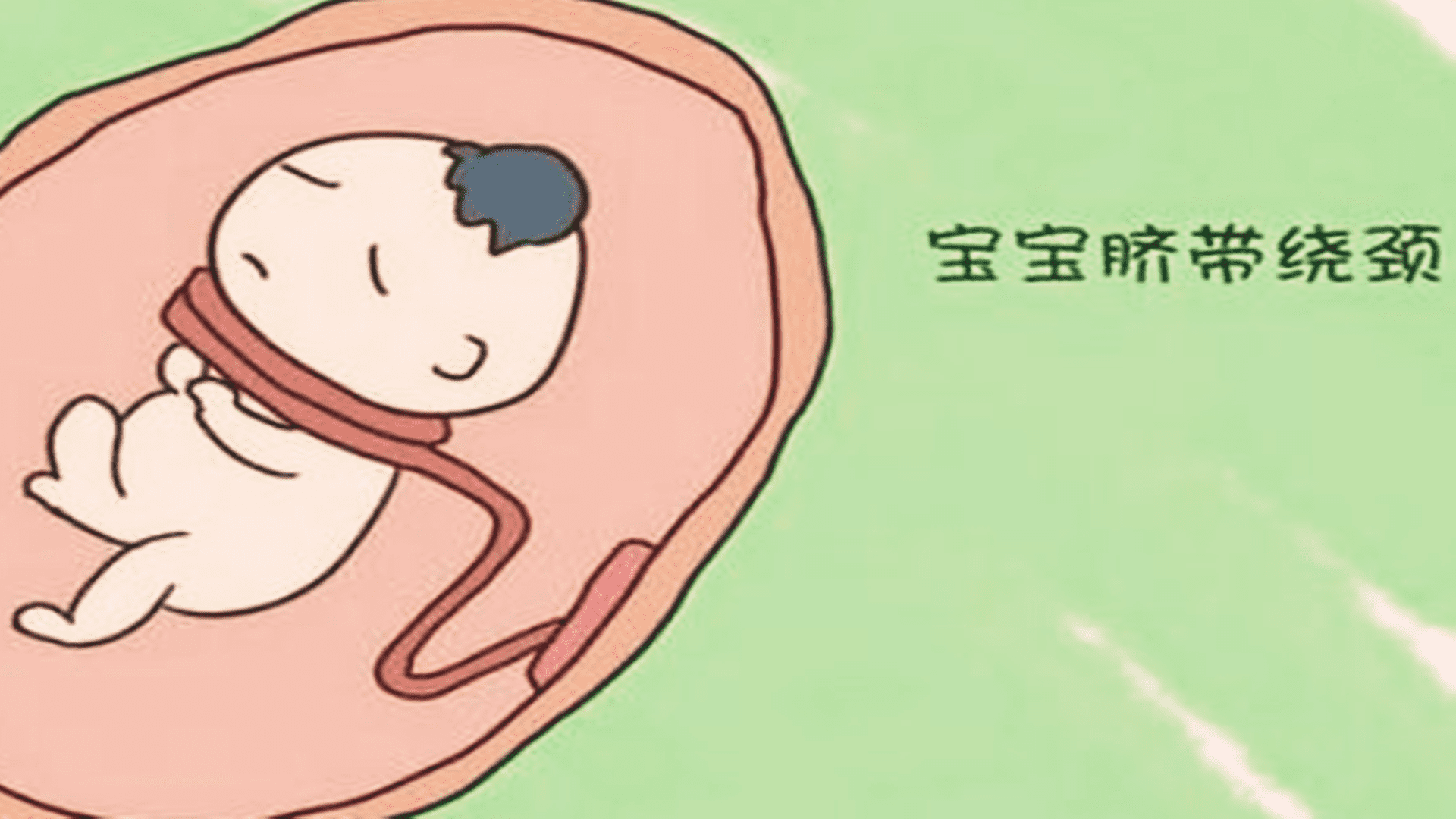 腹中胎儿脐带绕颈怎么办(胎儿脐带绕脖子怎么办)