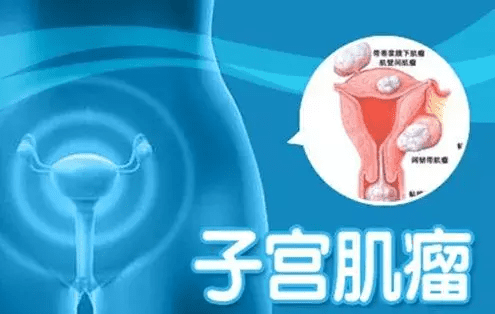 什么是子宫肌瘤的图片(哪种女人容易得子宫肌瘤)