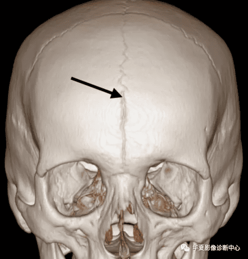 额头有骨缝是怎么回事额头两侧有骨缝