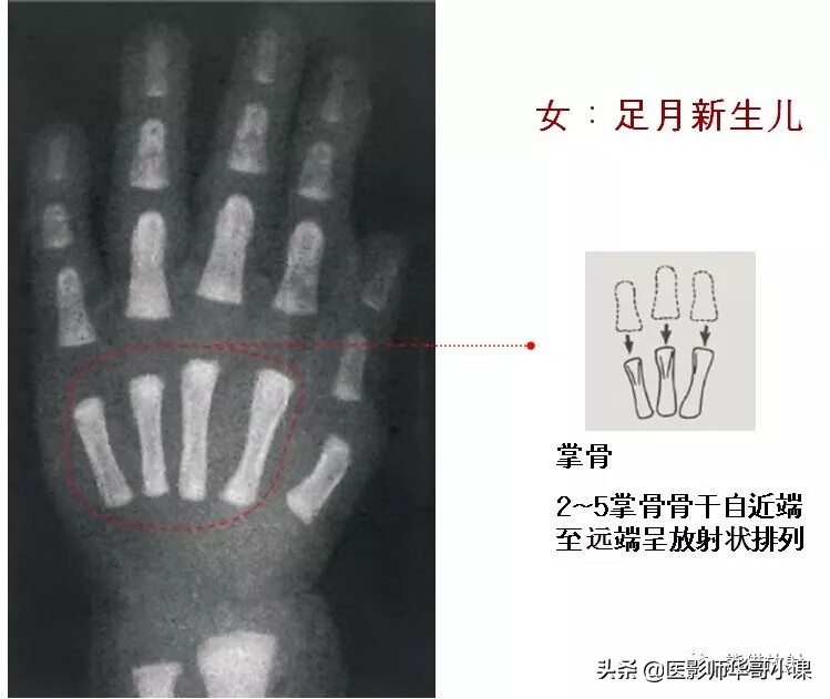 怎样测骨龄?(测骨龄的最佳年龄)