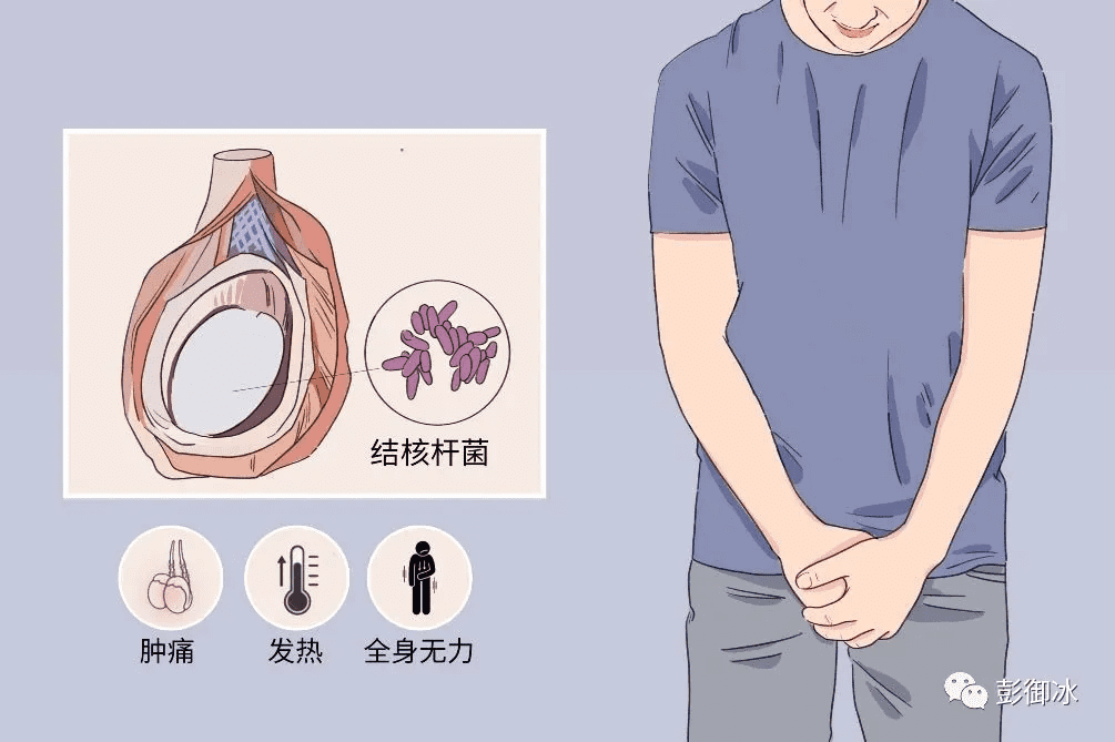 结核性附睾炎是怎么引起的(附睾炎打了十天点滴为什么还不好)