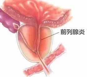 龟头敏感(什么药能根治龟头敏感)