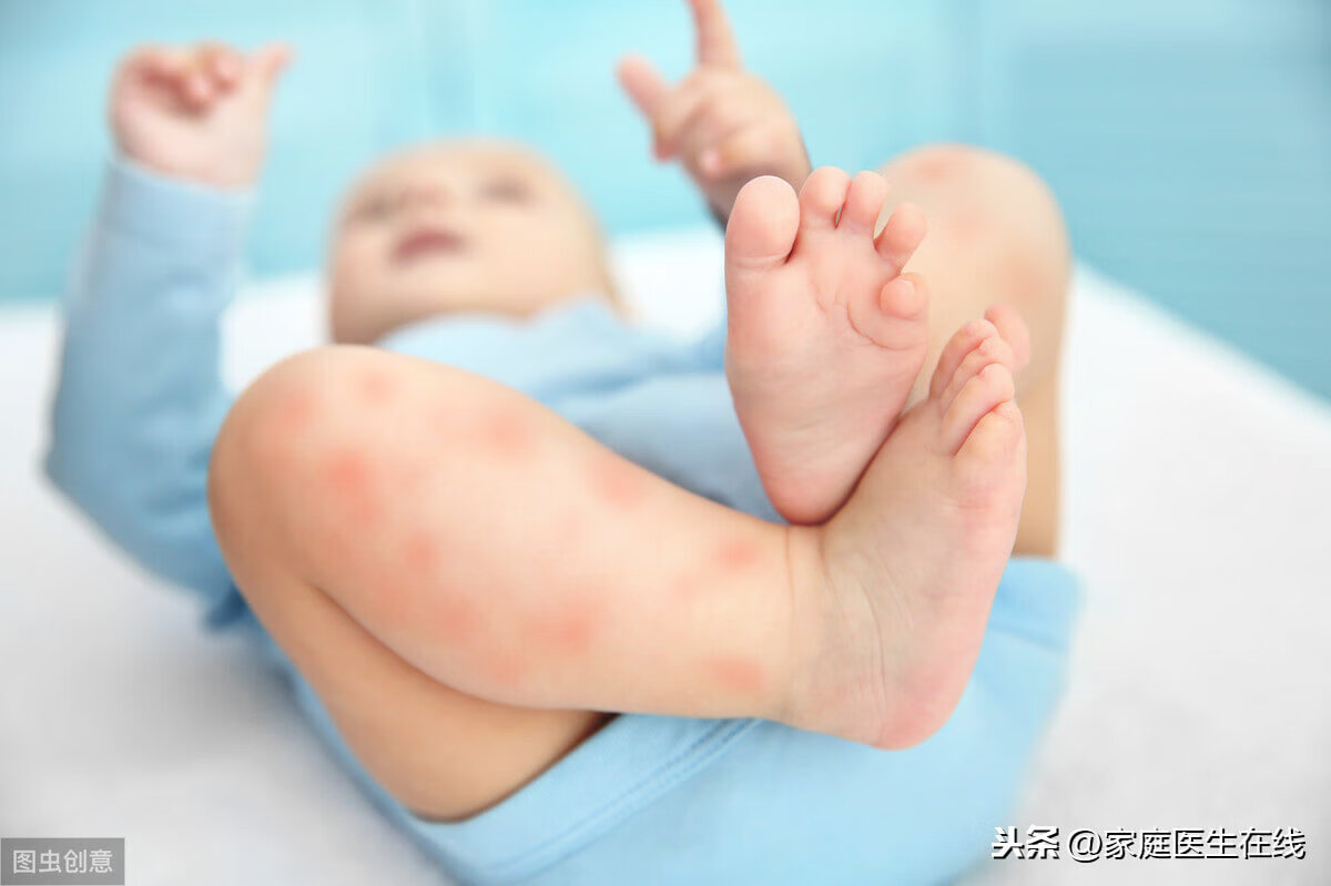 婴儿湿疹的原因是(婴儿湿疹是怎么引起的原因)