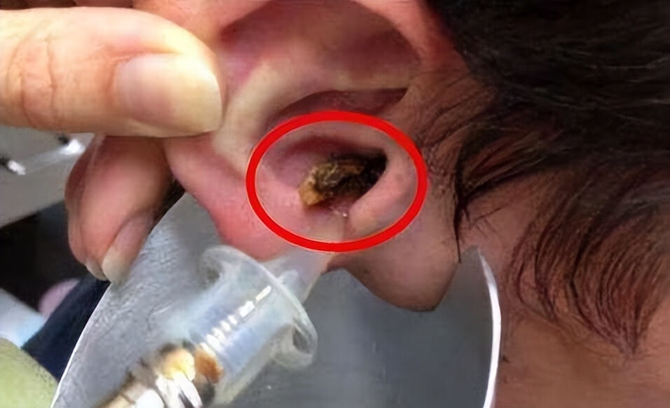 耳朵后面长了一个硬疙瘩是什么原因(耳垂根部长了个硬疙瘩)