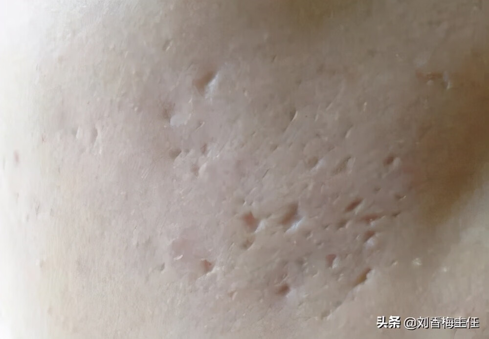 有痘坑怎么办啊(治疗痘坑最有效的方法是什么)