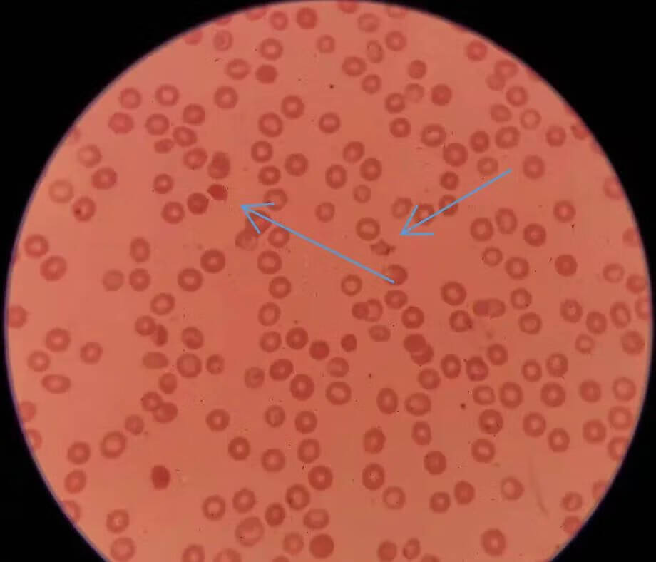 红细胞分布宽度偏低一点点(红细胞分布宽度偏低有什么危害)