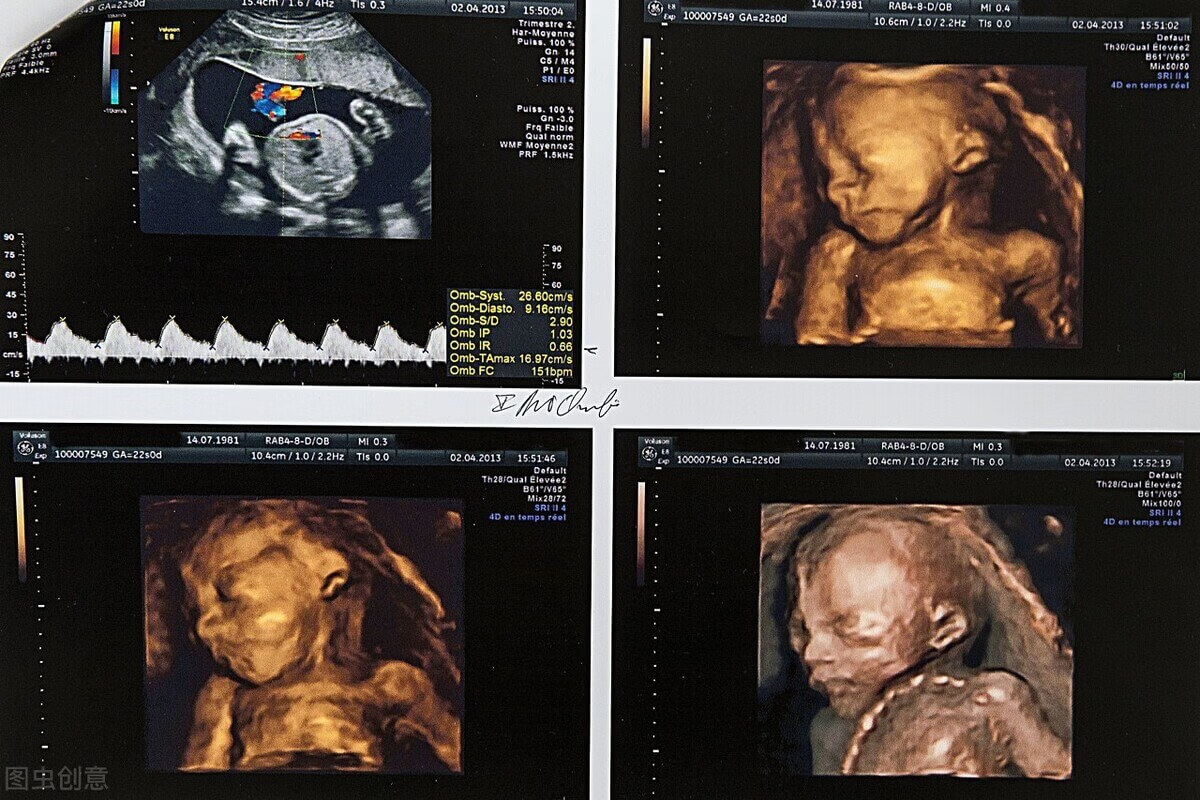 胎儿四维彩超性别照片(22周胎儿四维彩超图)