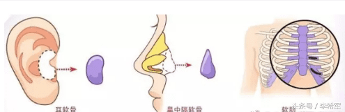 自体软骨隆鼻手术方法(耳软骨隆鼻手术过程)