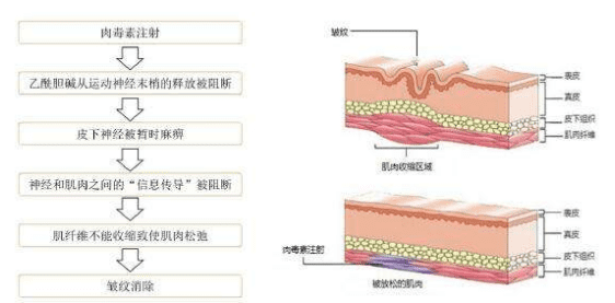 鱼尾纹怎么去除(去鱼尾纹)