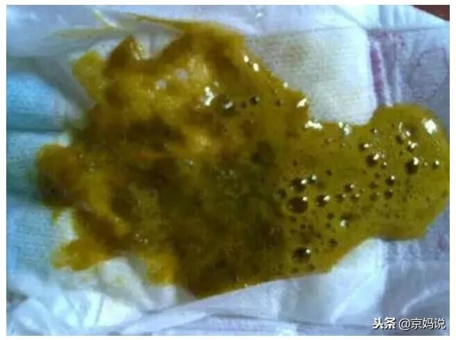宝宝大便发绿是怎么回事(2个月宝宝大便发绿)
