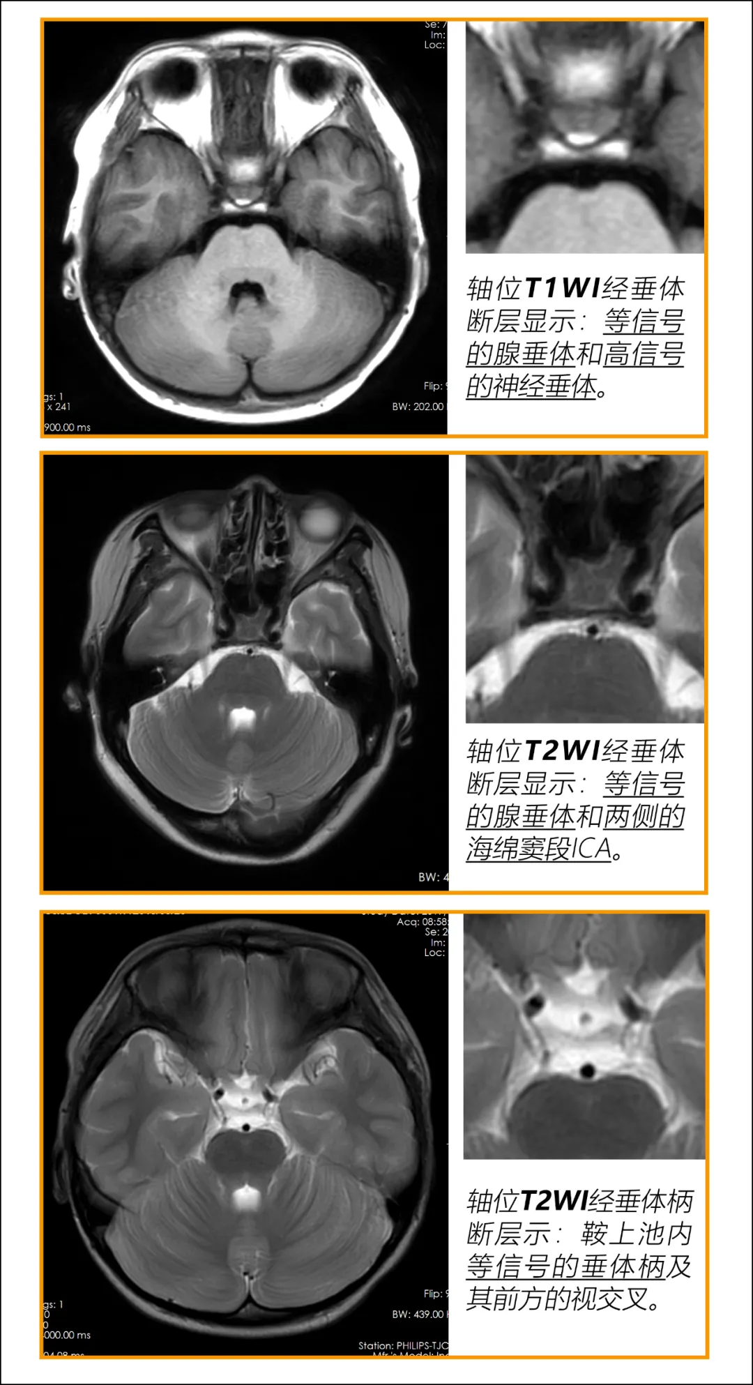 脑垂体的作用和功能(脑垂体干嘛用的)