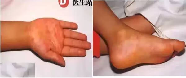 麻疹症状及原因(麻疹什么症状)